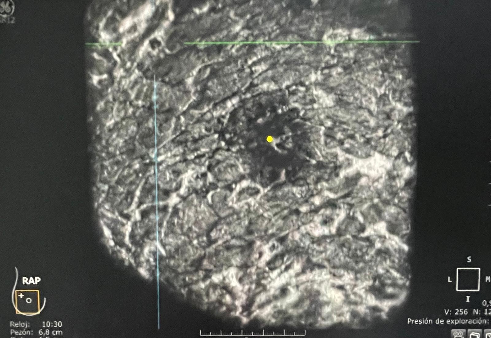 Reconstrucción coronal de ecografía automatizada
