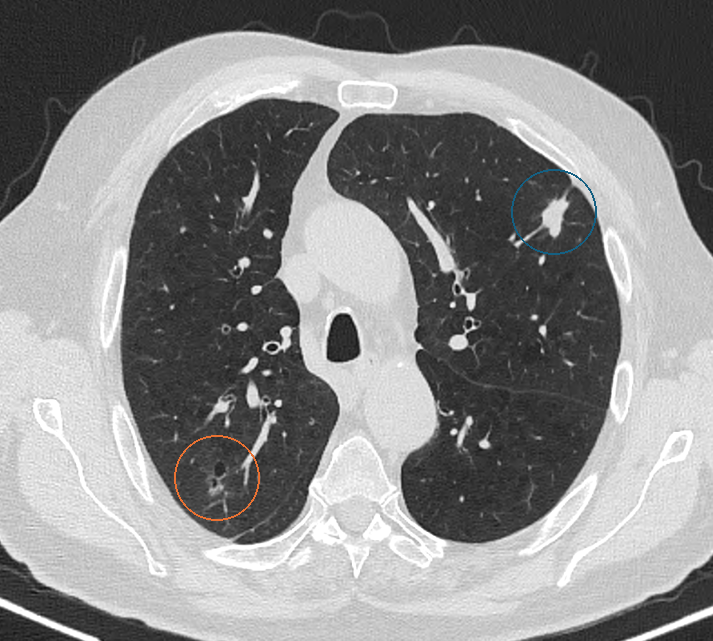 TC axial con nódulos pulmonares sólido y subsólido señalados