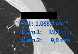 Medición tridimensional del volumen de un nódulo pulmonar